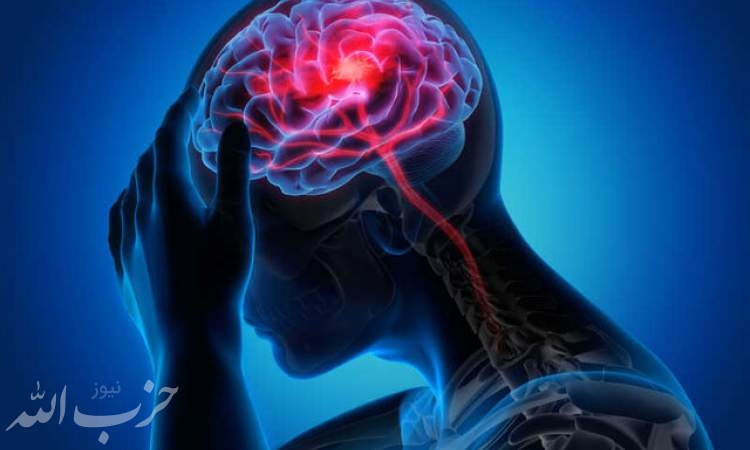 علائم اصلی سکته مغزی چیست؟/ تاثیر میگرن در این بیماری